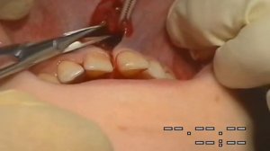 Пластика короткой уздечки верхней губы. Френулопластика.