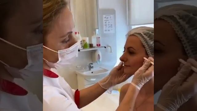 AestheFill филлер на основе полимолочной кислоты смотреть онлайн