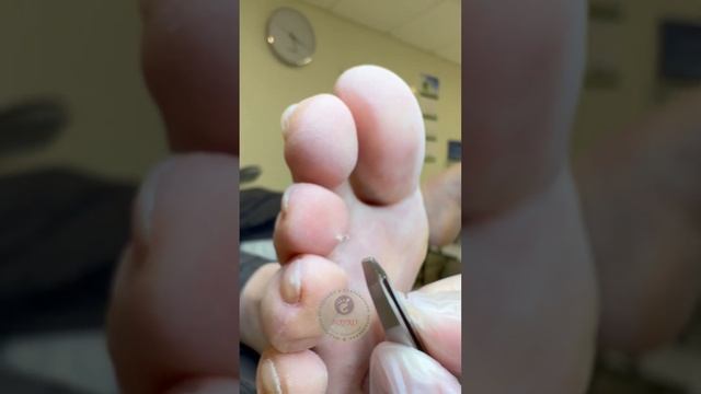 Так сказать «вросший» волос. смотреть онлайн