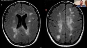 Аутоиммунный энцефалит