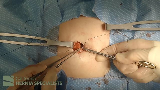 Open Umbilical Hernia Repair At California Hernia Specialists (4K)