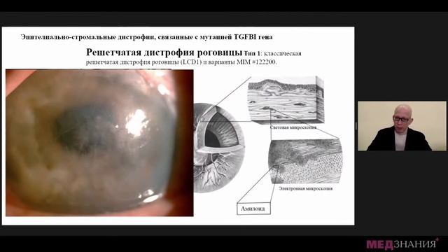 13. Дистрофии роговицы. Труфанов Сергей Владимирович смотреть онлайн