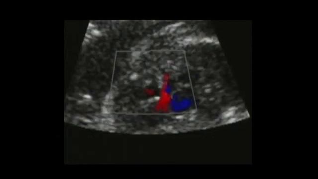 Тетрада Фалло у плода, пренатальная диагностика в 24 недели гестации. смотреть онлайн