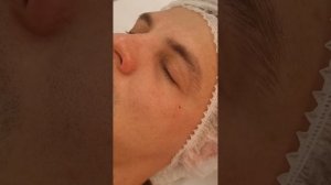 Удаление милиумов (белый угорь, просянка)