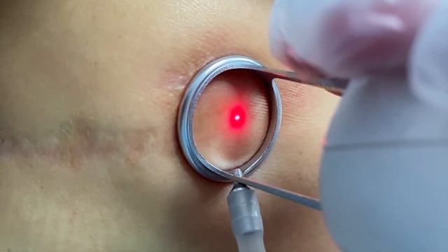 Удаление Шрама Фракционным Лазером смотреть онлайн