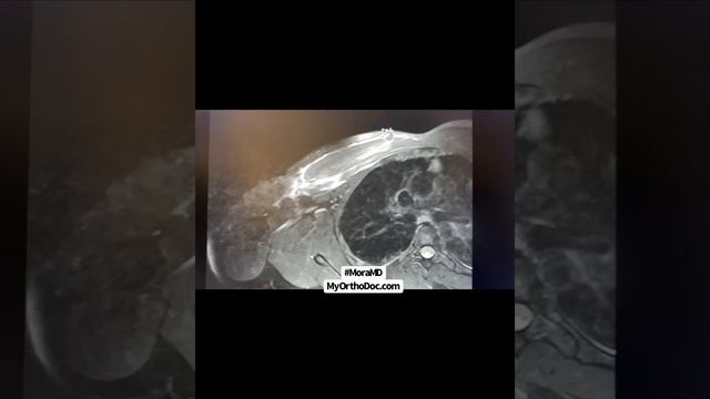 Pectoralis Major Tendon Repair. A MUST WATCH смотреть онлайн