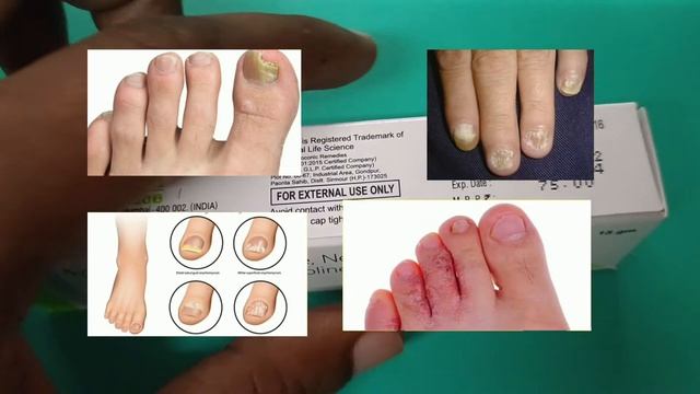 D drem kt cream use in hindi | ketoconazole neomycine clobetasole tolnafate iodochloro | दाद खाज смотреть онлайн