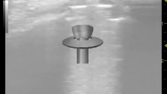 Винт стяжка после лечения перелома большеберцовой кости смотреть онлайн