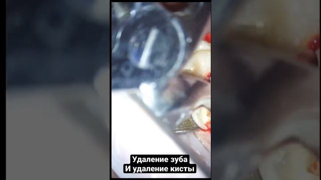 Удаление зуба , удаление кисты зуба , киста в зубе , стоматолог лечение , удаление зуба мудрости смотреть онлайн