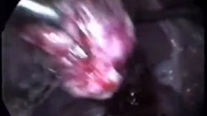 Ретроцервикальный эндометриоз с прорастанием стенки прямой кишки. Передняя резекция кишки.