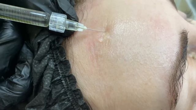 БЛАНШИРОВАНИЕ МОРЩИН ЗОНЫ ЛБА смотреть онлайн