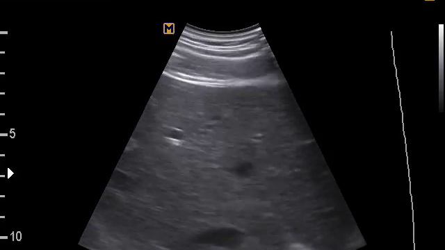 Конкремент желчного пузыря, подвижный (2-8-17) смотреть онлайн