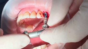 Удаление зуба и сразу имплант