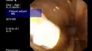 Сенсация! Управляемая видеокапсула для капсульной эндоскопии MiroCam Navi. Демонстрация.