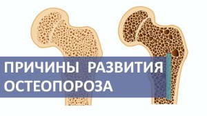 ? Что такое остеопороз, как он проявляется, каковы факторы развития. Что такое остеопороз. 12+