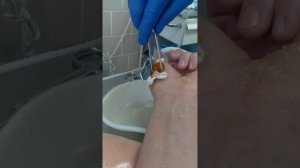 Удаление спиц. Больно ли удалять спицы? если честно нет не больно.