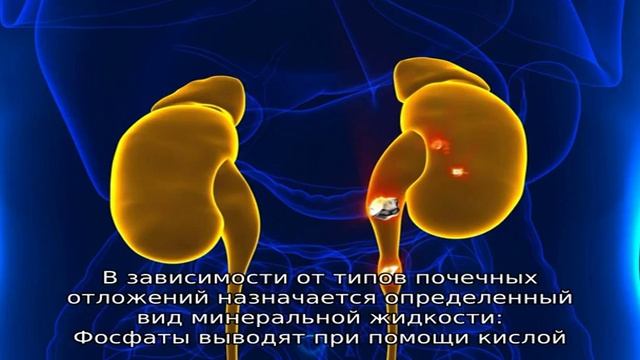 Оксалатные камни в почках смотреть онлайн