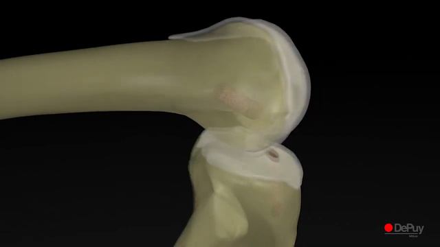 Femoral INTRAFIX® смотреть онлайн