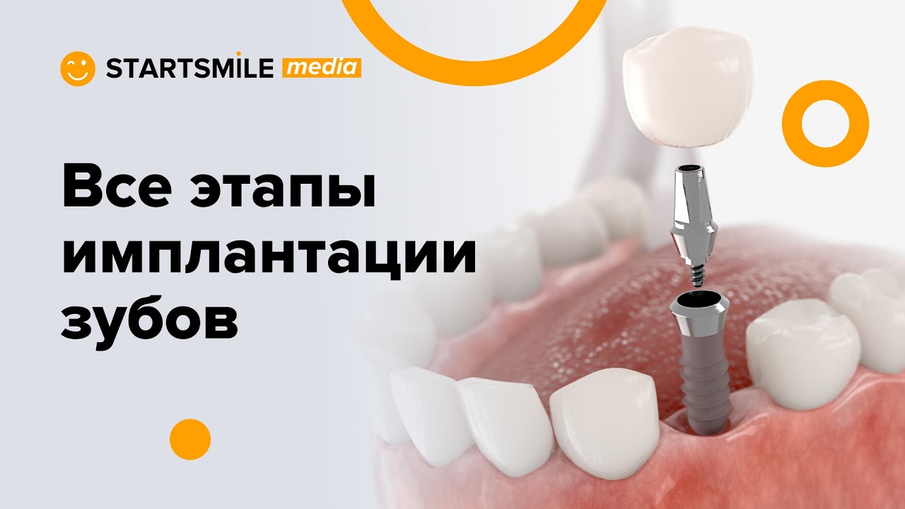 Установка импланта зуба | Все этапы операции смотреть онлайн