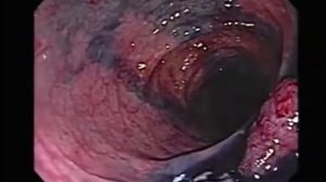 Полипэктомия сигмовидной кишки