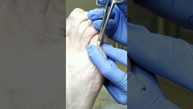 Обработка стержневой мозоли на мизинце, подолог Ольга Кострюкова смотреть онлайн