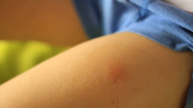 УКУС КЛОПА | Как он выглядит и чем его смазывать и как избавиться от клопов смотреть онлайн