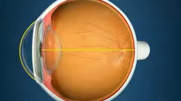 Близорукость (миопия)