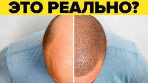 Все о пересадке волос у мужчин. Этапы пересадки волос: от подготовки до операции.