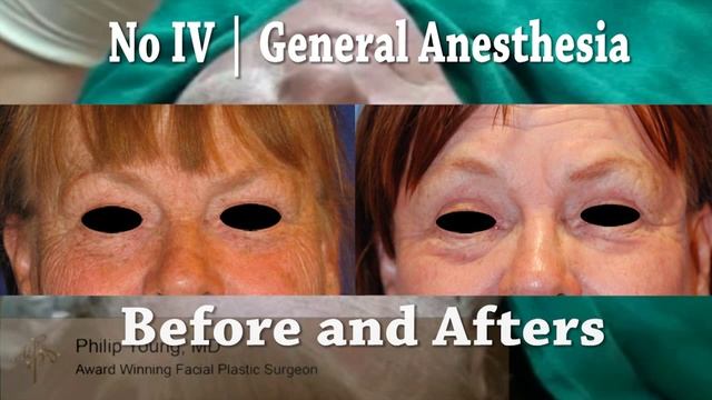 Laser Resurfacing Eye lift by Dr. Philip Young in Bellevue Seattle Washington смотреть онлайн