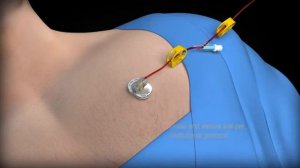 Видео инструкция по применению иглы Губера