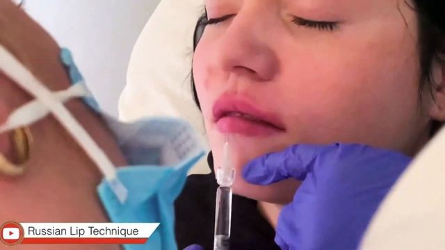 Russian Lip Technique ! Lip Lifting Technique ! Perfect Lips