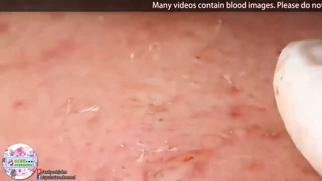 УГРИ ПРЫЩИ НА ЛИЦЕ! Угри на лице! Давлю! Как избавиться от прыщей! Черные точки смотреть онлайн