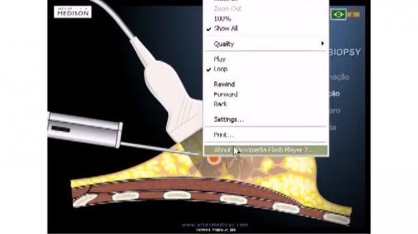 Применение ультразвуковой шкалы BI-RADS в интервенционной маммологии.