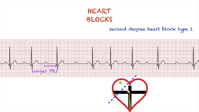 Heart Blocks Interpretation: Easy and Simple смотреть онлайн