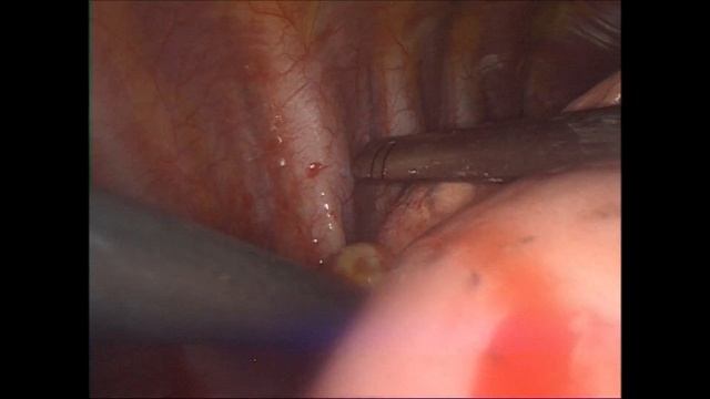 VATS for Spontaneous Primary Pneumothorax смотреть онлайн