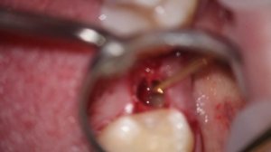 Закрытый синус лифтинг под микроскопом