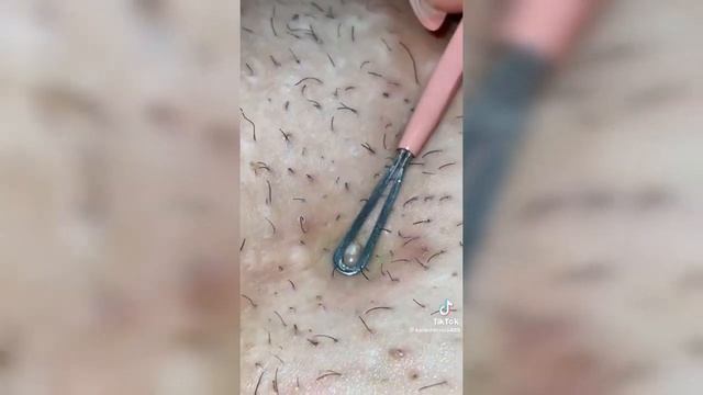 чистить лицо от прищей смотреть онлайн