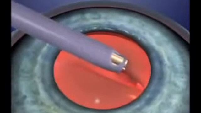 Cirugia de Catarata por Facoemulsificacion смотреть онлайн