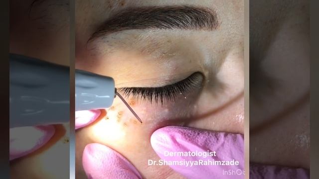 Удаление милиумов (жировиков) аппаратом Плекср. ☎️0502130677 Dermatoloq Shamsiyya Rahimzade смотреть онлайн