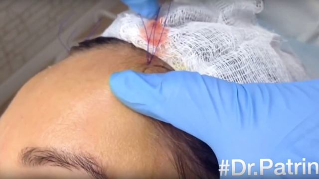 Антитренды косметологии: "Плоские губы"//"Лисьи бровки"//"Губы-уточки" и другие! смотреть онлайн