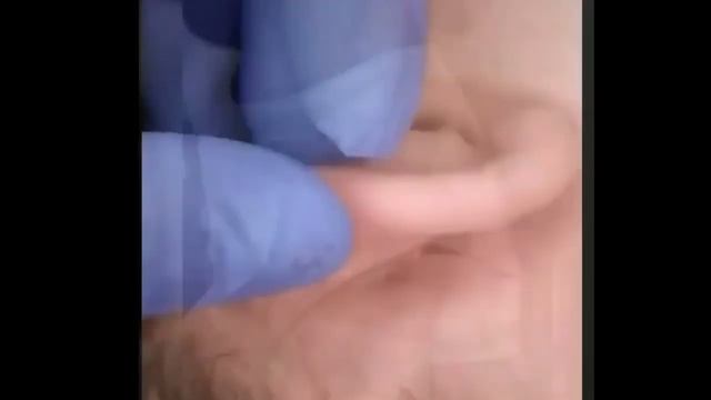 ВЫДАВЛИВАНИЕ ОГРОМНЫХ УГРЕЙ И ПРЫЩЕЙ В УШАХ!