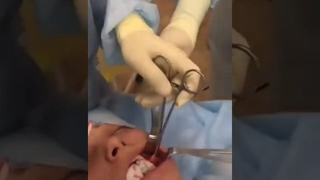 Резекция Комков Биша