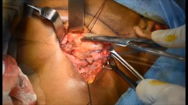 Submandibular gland excision -step by step смотреть онлайн