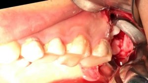 Impacted Wisdom Tooth (2.8) / Удаление зуба мудрости (сложное)
