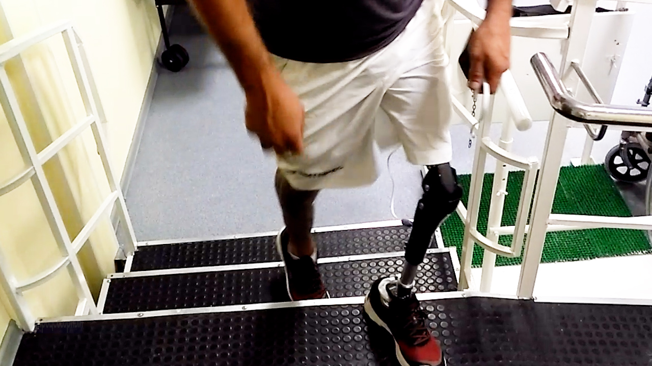 С микропроцессором на протезе ноги - забытые ощущения ходьбы вверх по лестнице. смотреть онлайн