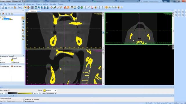 Загрузка DICOM файлов и расчет 3D модели смотреть онлайн