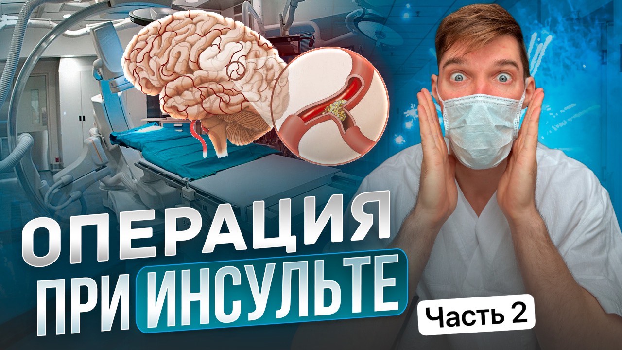 Удаление тромба из мозга. Операция при ОНМК. Цена и кому она показана, в какие сроки. смотреть онлайн