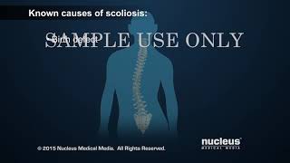 Scoliosis ¦ Scoliosis Surgery ¦ Nucleus Health