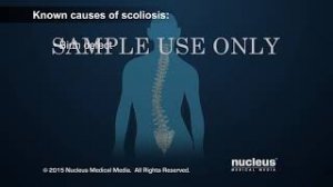 Scoliosis ¦ Scoliosis Surgery ¦ Nucleus Health