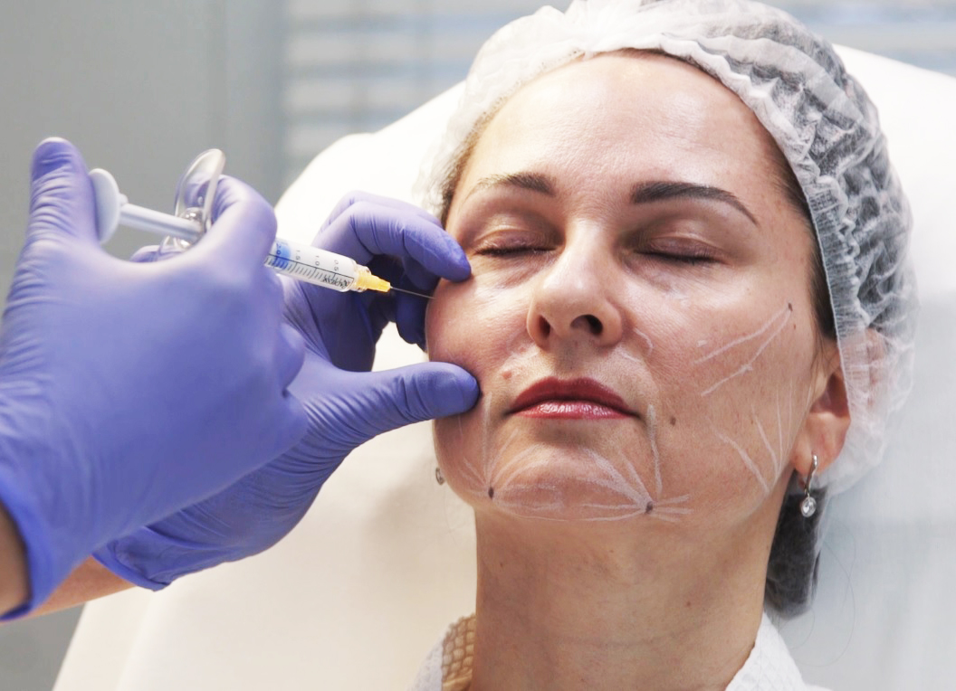 Контурная пластика филлером: объемная коррекция лица. смотреть онлайн